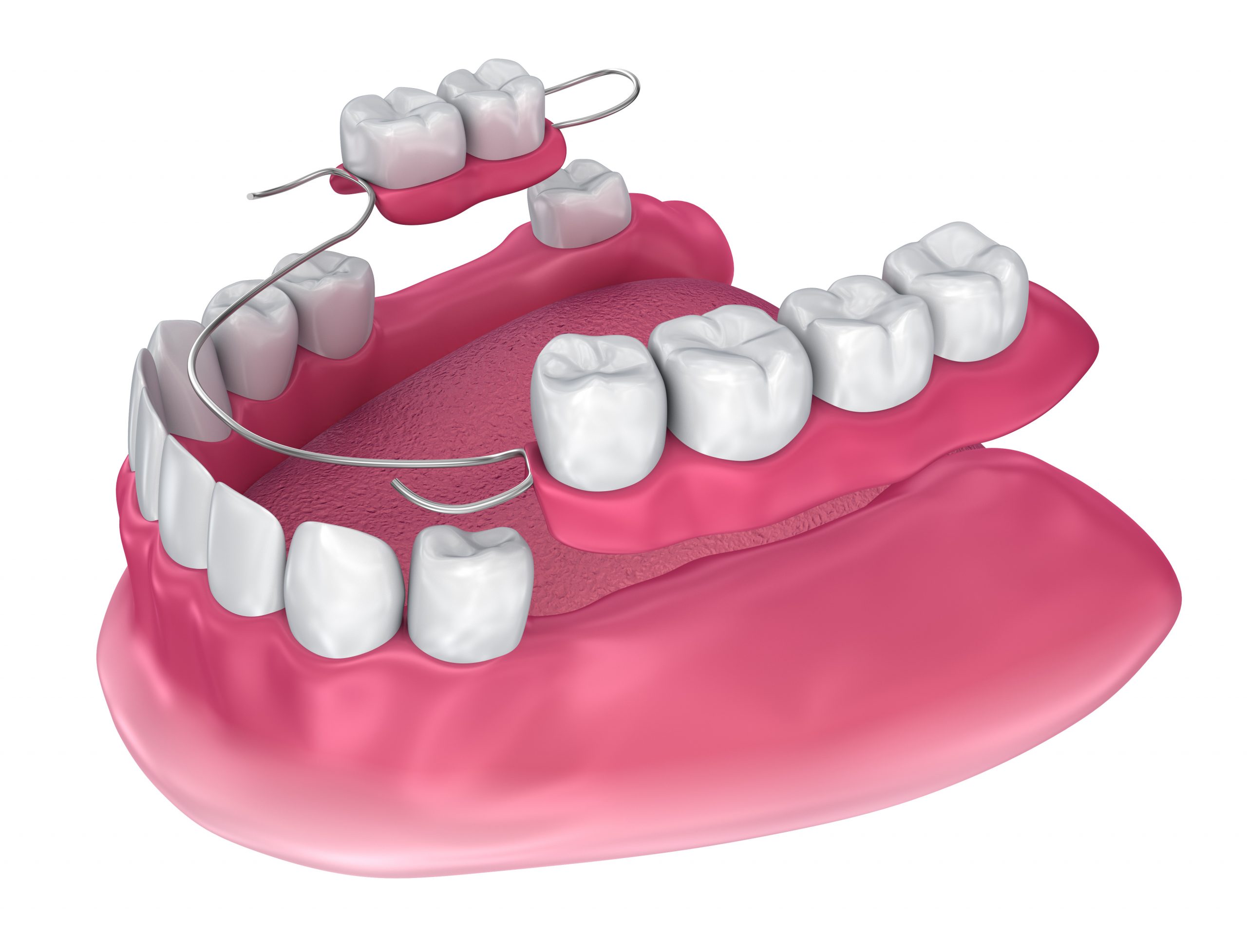Removable partial denture. Medically accurate 3D illustration
